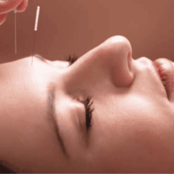 Acupunrura facial